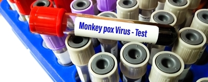 Що варто знати про вірус мавпячої віспи? 